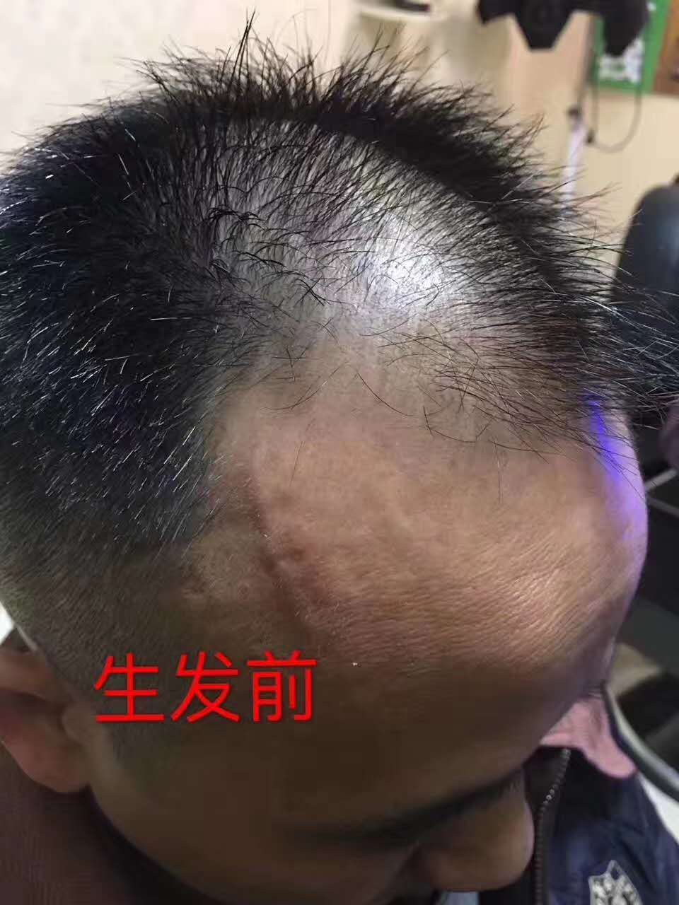 脂溢性脱发治疗脱发成功案例,脂溢性脱发如何生发最有效