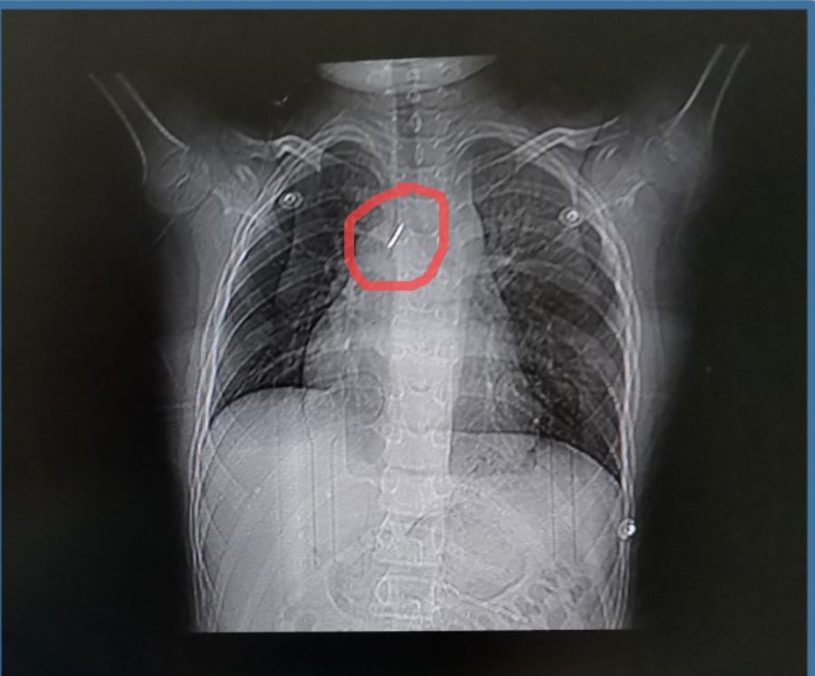 小孩气管发生异物时采用什么急救,10岁男孩口含图钉玩耍呛入气管