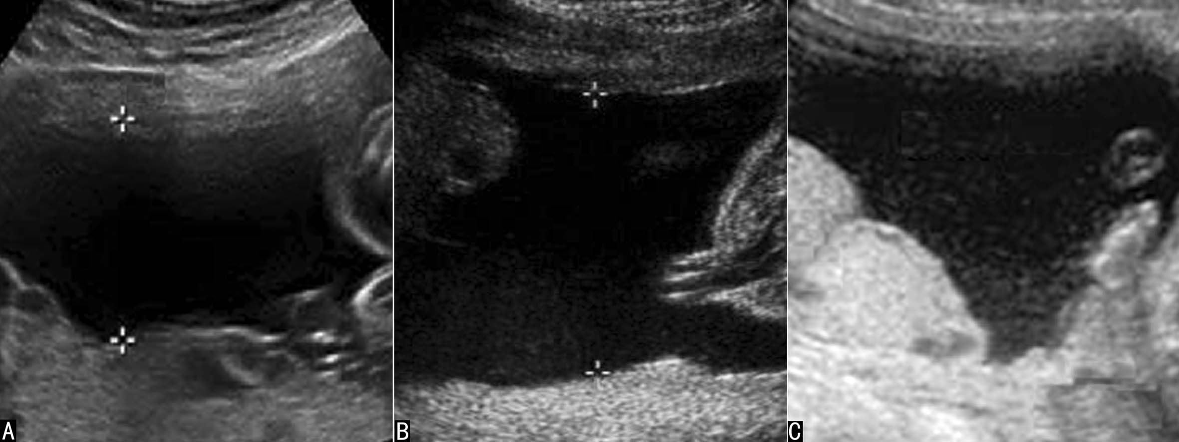 明明白白做超声（十九）：羊水和胎膜超声检查