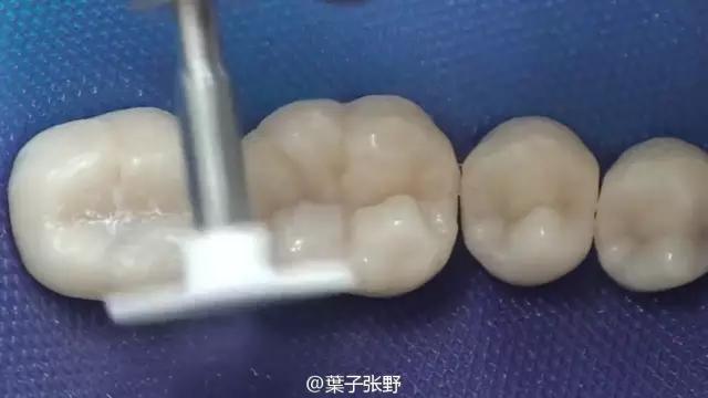 补牙疼吗补牙过程图,补牙全部过程是什么样子的