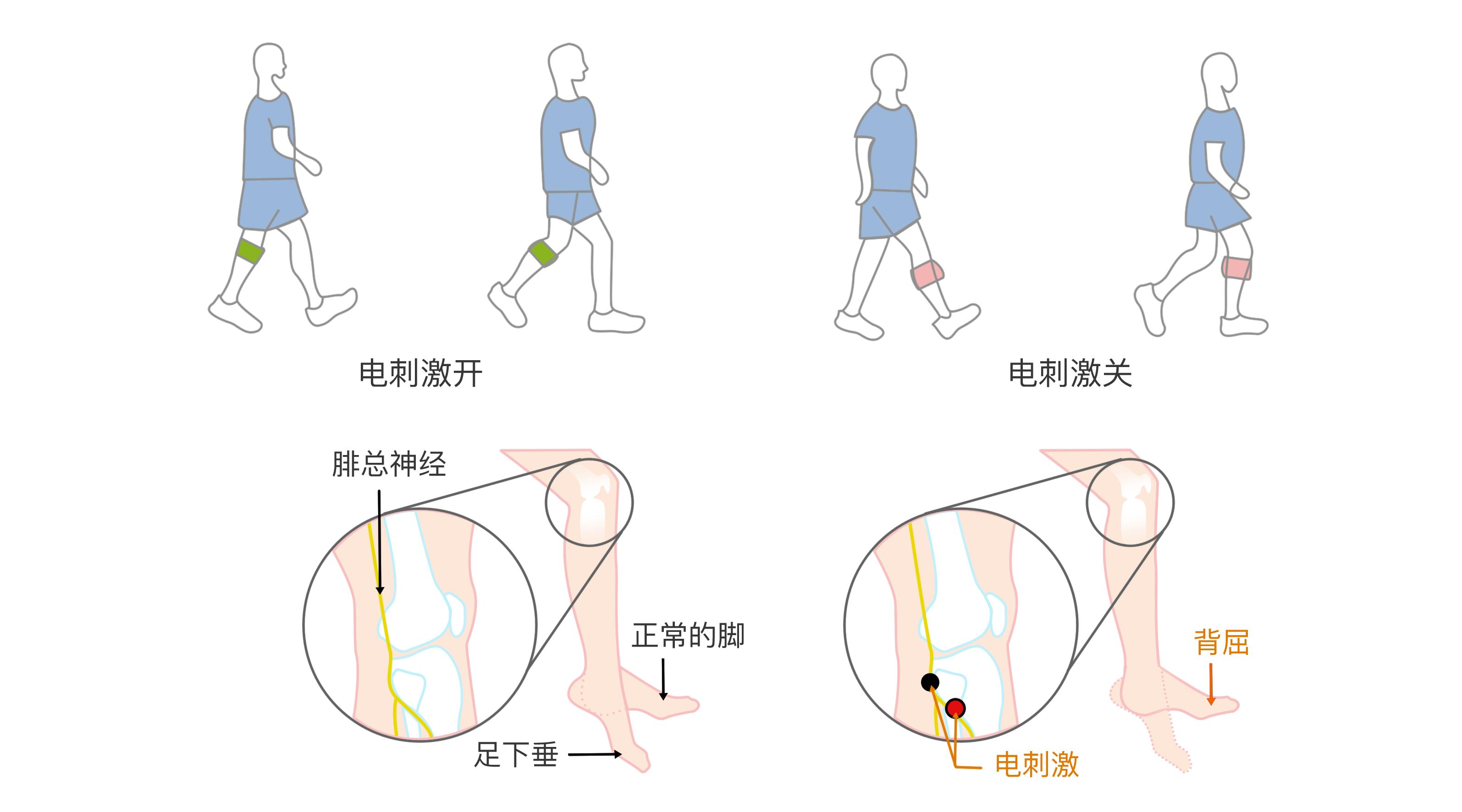 FES在脑卒中康复治疗中的应用分析