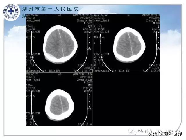 头皮裂伤缝合手术切口分类,头皮切口