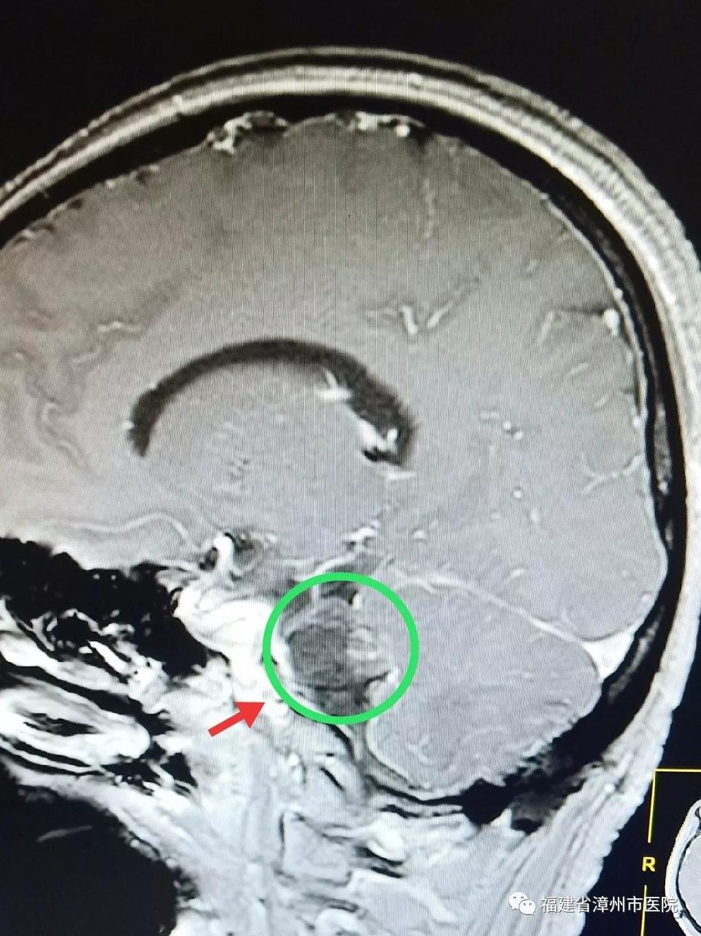 听力下降是耳朵出问题吗,着急一侧耳朵耳鸣听力减退