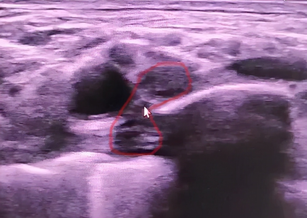 手麻肌电图检查过程视频,手麻脚麻肌电图正常