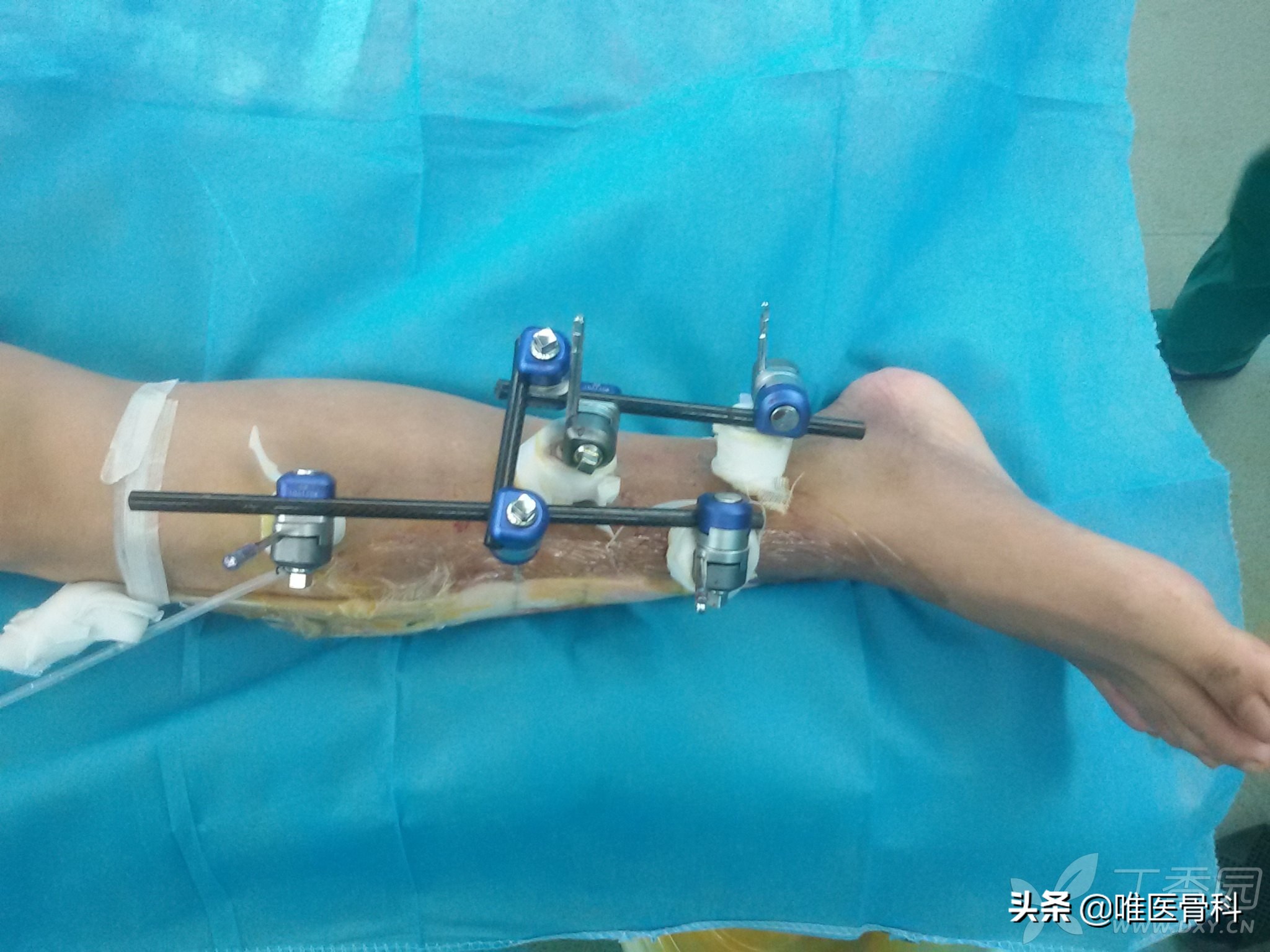 外固定多久恢复,外固定取出一般多久