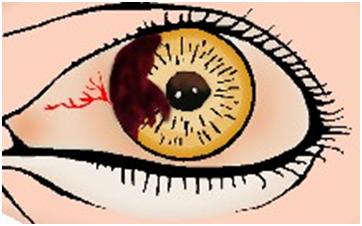 电焊伤眼睛的急救办法,眼睛外伤的最佳治疗方法