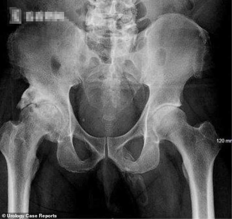 14岁男生把9厘米缝衣针插入尿道,痛苦三天去就医,网友:爽吗?