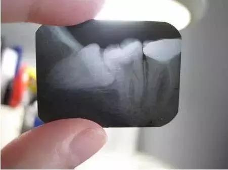 智齿冠周炎张口受限伴吞咽疼痛,智齿冠周炎一般疼痛多久