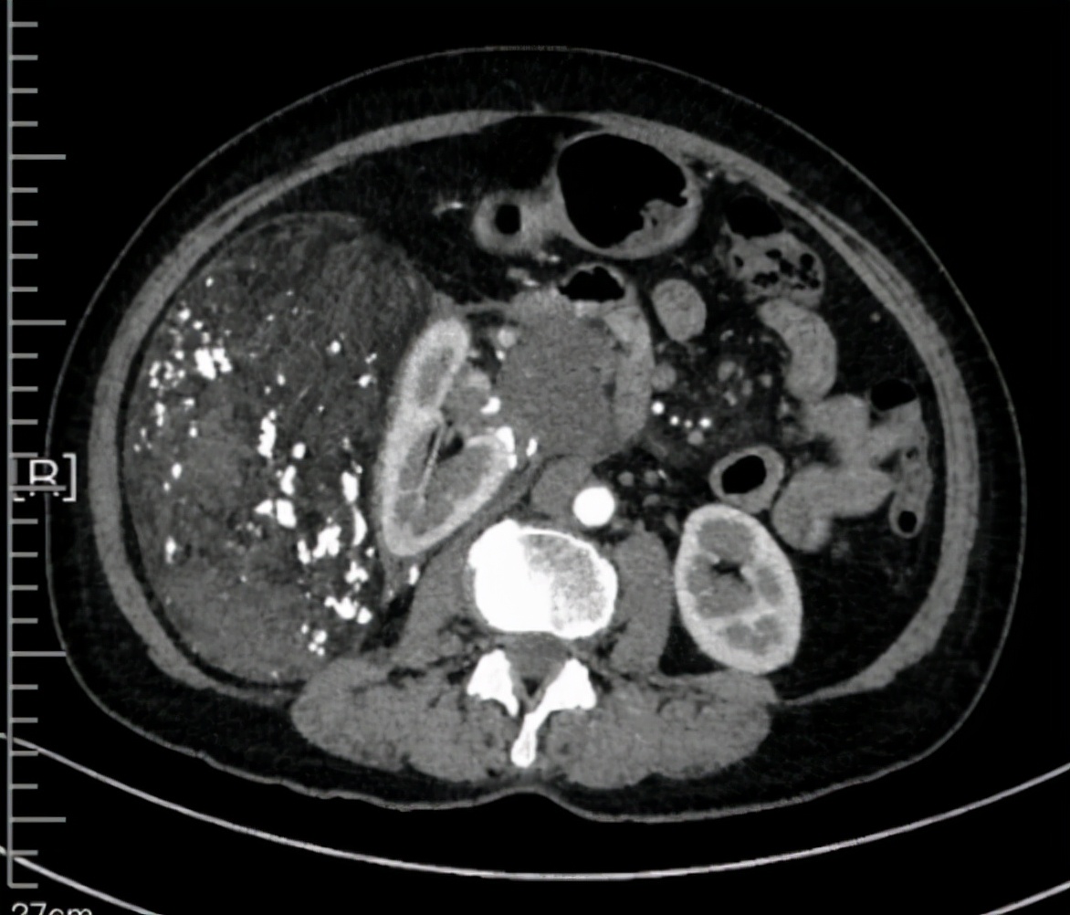 罕见脂肪肉瘤,高分化腹膜后脂肪肉瘤能治好吗