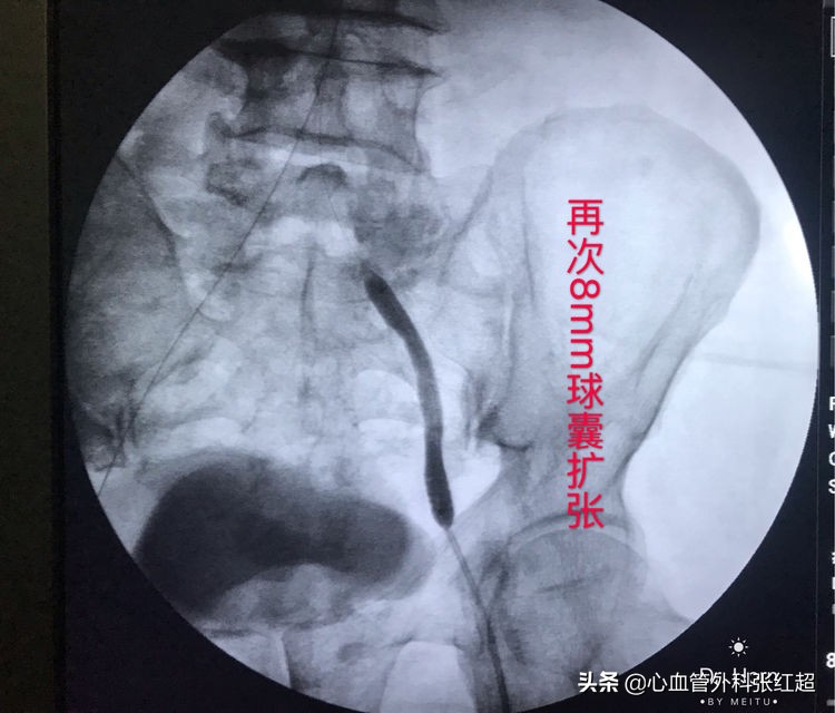 外周血管外科治疗范围,外周血管介入治疗疗程