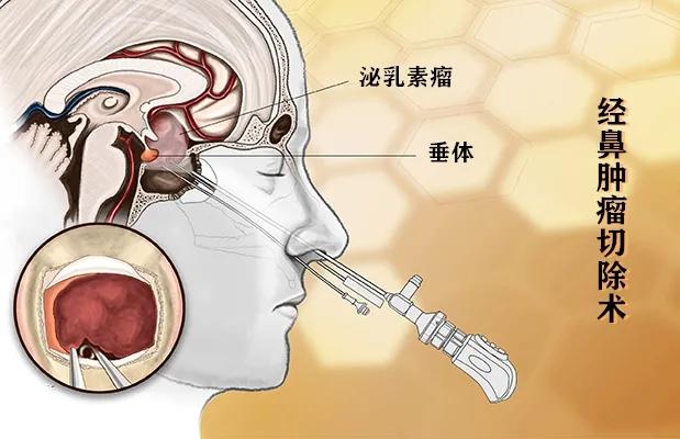 男性乳房发育症改善,男性胸部腺体发育能流奶吗