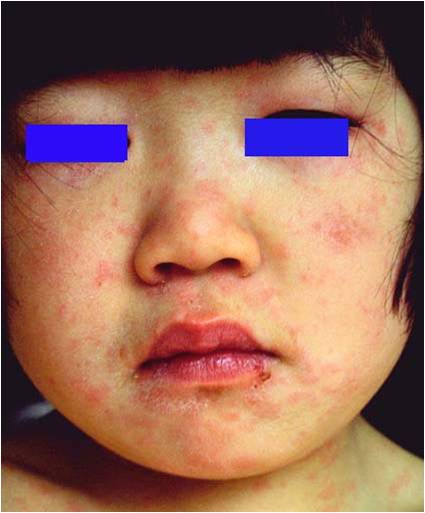 发热性皮疹,成人发热伴皮肤出疹