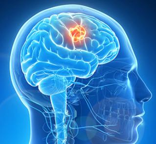 脑卒中如何治疗,脑卒中是什么如何康复治疗