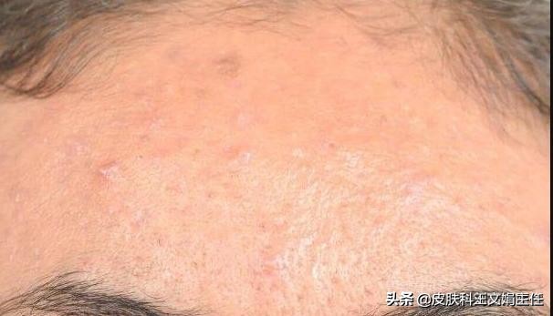 皮肤病的10种常用药治疗,18种常见皮肤病用药