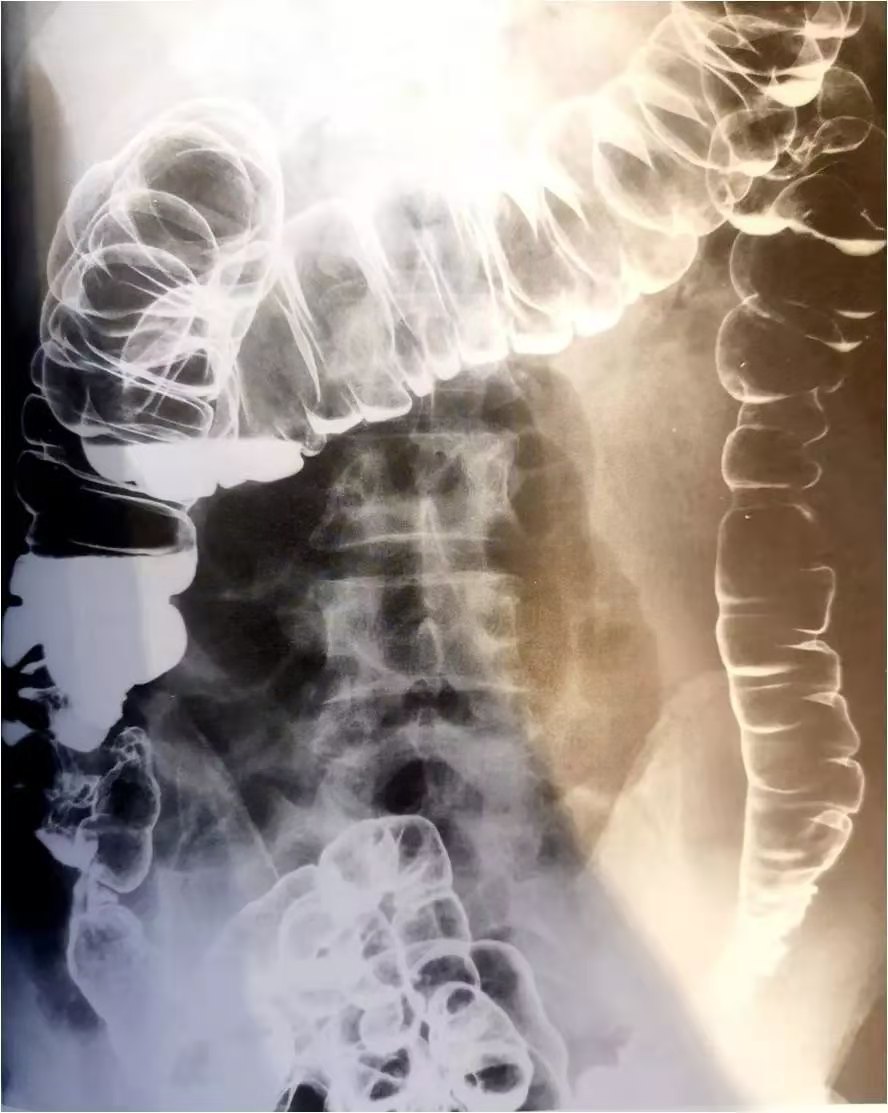 药物性结肠炎治愈方法,中成药可否根除溃疡性结肠炎