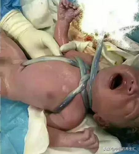 婴儿脐带处绳子缠绕最佳解决方法,宝宝绑脐带全过程