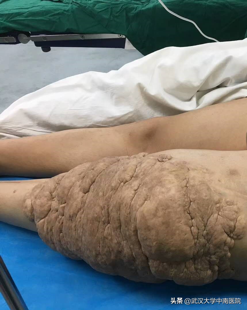 大的脂肪瘤能发生恶变吗,10公分脂肪瘤手术