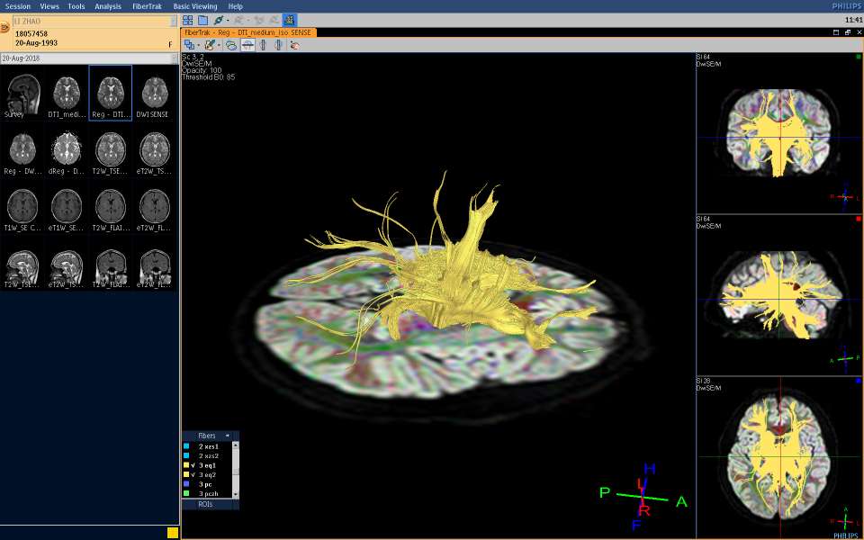 强迫症最好的治疗方法,小柴胡汤治疗强迫症