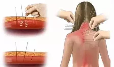 胳膊疼抬不起来理疗手法,胳膊疼的抬不起来怎样锻炼