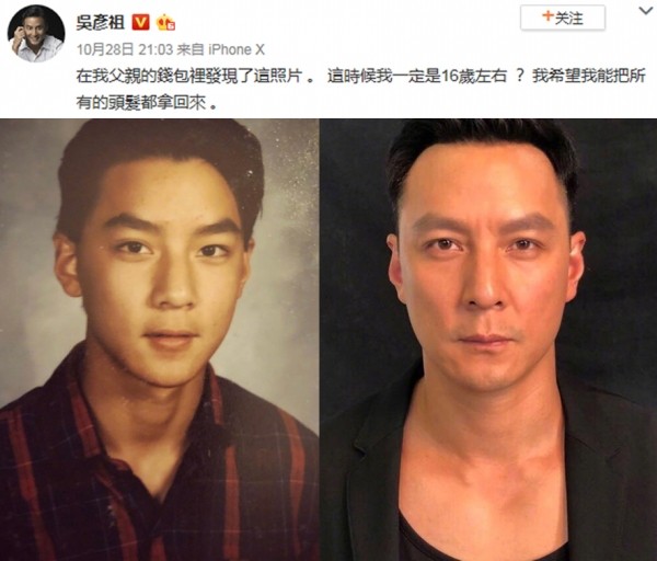 小贝热搜,小贝脱发