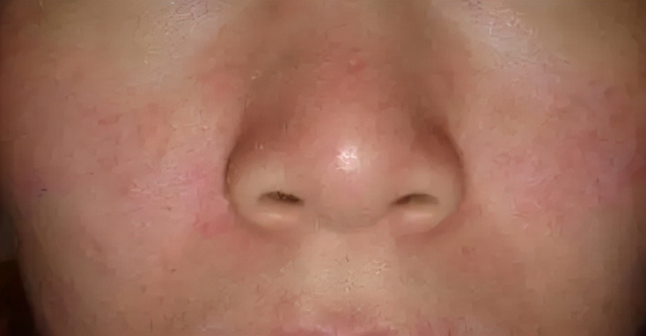 外用药物有刺激，想弃疗，可以这么整