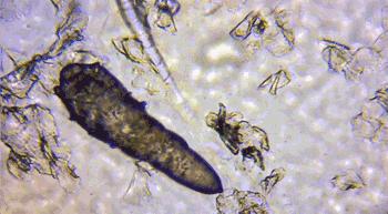 痘痘挤出的白米粒,痘痘挤出白点和血算干净了吗