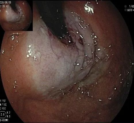 贲门处见隆起性病变,贲门高级别瘤变esd术后不能吃什么