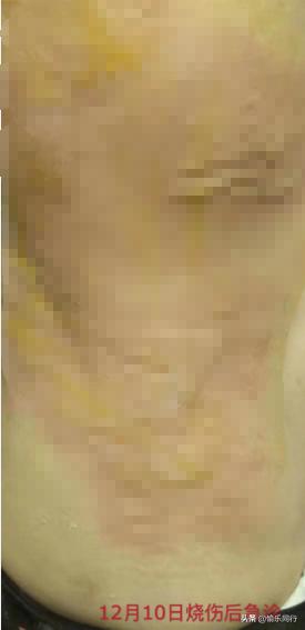 邓莎被火罐烧伤的电影,邓莎拔火罐被烧伤后续