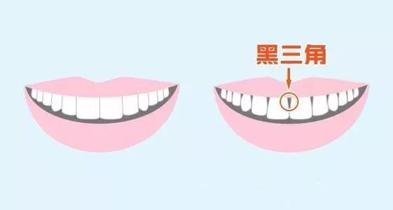 牙龈里的黑东西是什么,牙龈间有黑东西怎么办