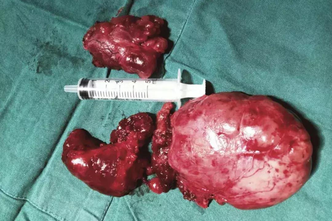 微创纵隔良性肿物切除术,微创显微技术切除肿瘤