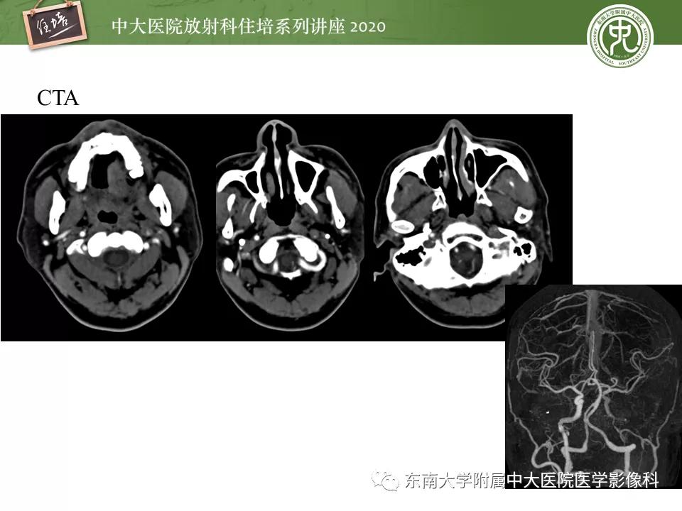 颈动脉夹层的超声表现及漏诊分析,动脉夹层与夹层动脉瘤是一样的吗
