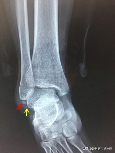 什么样的脚踝骨折适合保守治疗,什么样的腿骨骨折需要手术