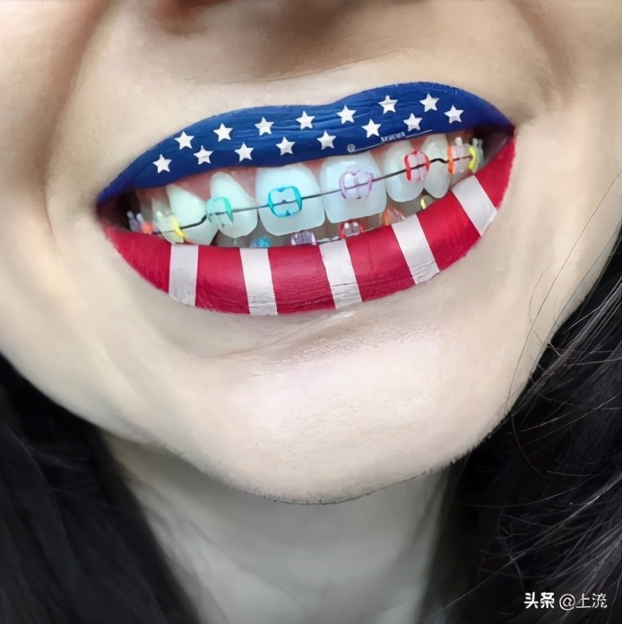 泰国流行戴牙套,泰国最近很火的牙套