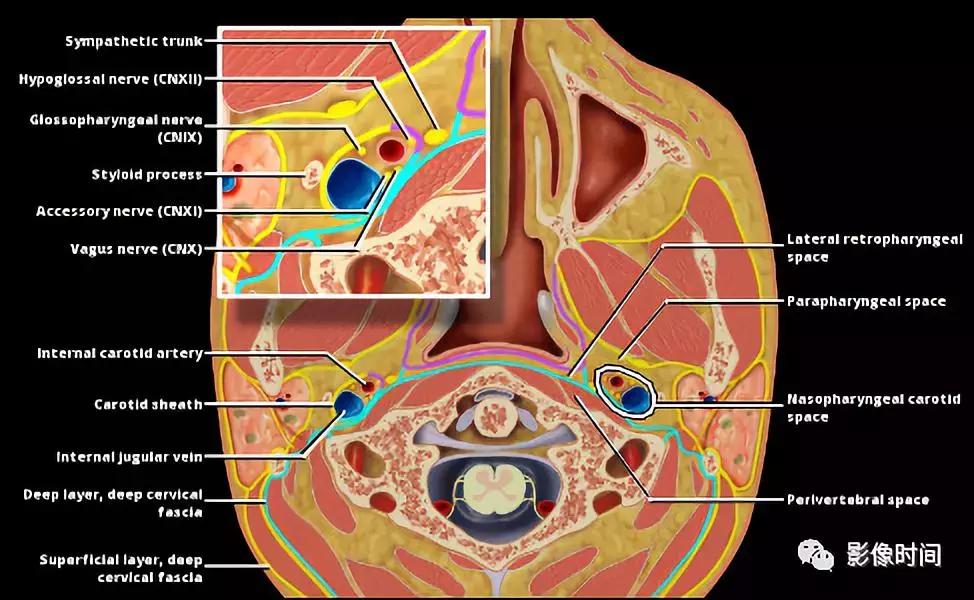 双侧颈动脉鞘间隙多发小淋巴结影,双侧颈动脉间隙多软组织密度结节