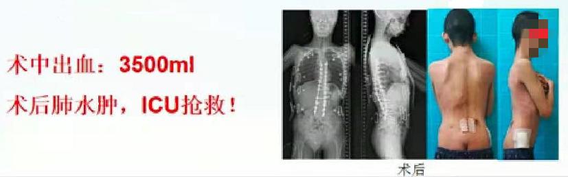 成人脊柱畸形矫形策略是什么,脊柱畸形医疗救治