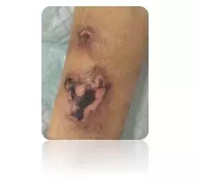 输液时肌腱损伤怎么办,输液造成组织坏死