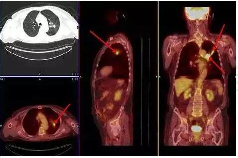 检查手段五花八门该如何抉择?医生教你选择肺癌诊断的最佳手段
