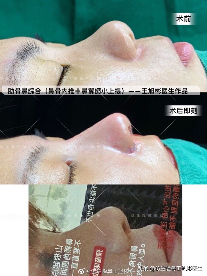 鼻翼整形矫正过程,鼻整形鼻尖下垂怎么办