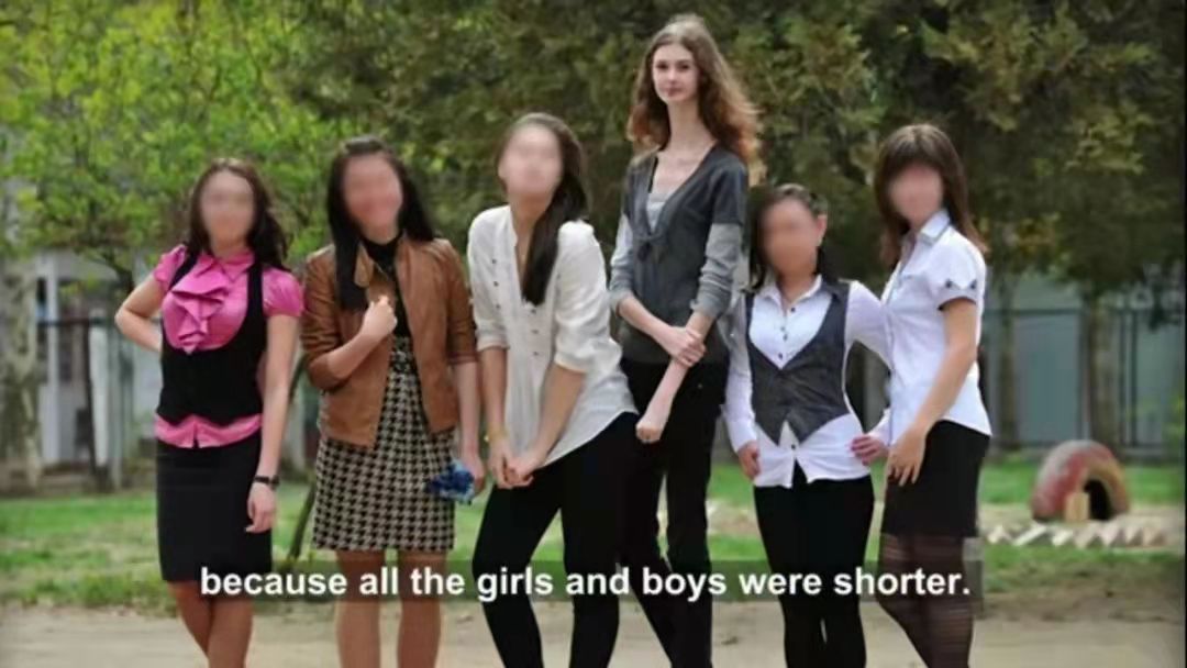 女孩得“肢体细长症”脖子18厘米长，从自卑抑郁变成自信仙女