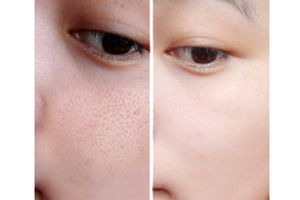 护肤套装收缩毛孔去黑头祛痘,男士去油保湿收缩毛孔护肤方法