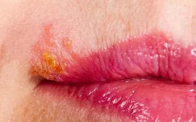 口唇疱疹好了上嘴唇又起泡结黄痂,嘴角疱疹和上火长泡的区别