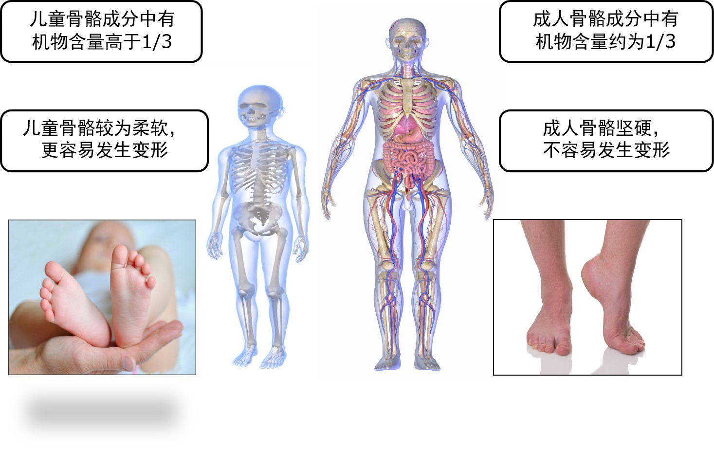 运动足外翻怎么矫正,运动引起脚大拇指外翻怎么矫正