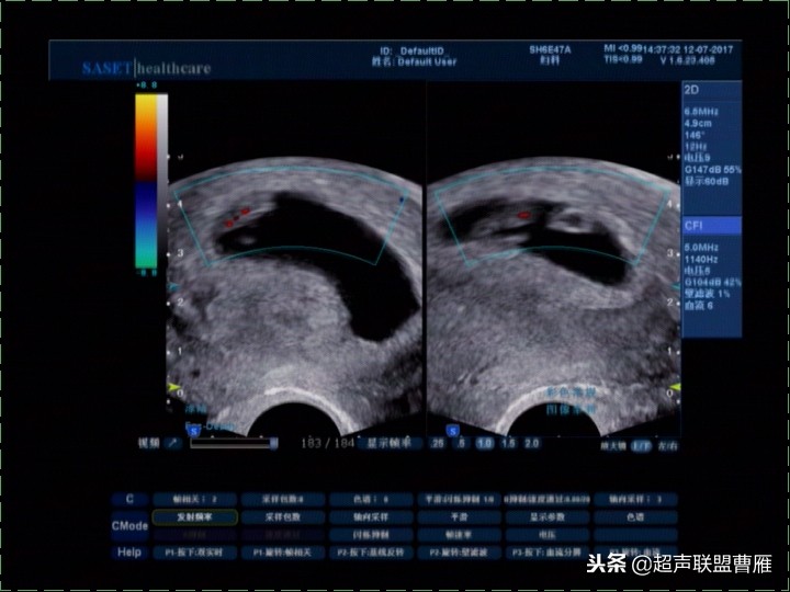 内见卵黄囊,卵黄囊肿瘤