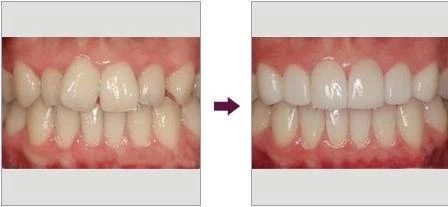传统矫正pk隐形矫正,牙齿隐形矫正和固定矫正的利弊
