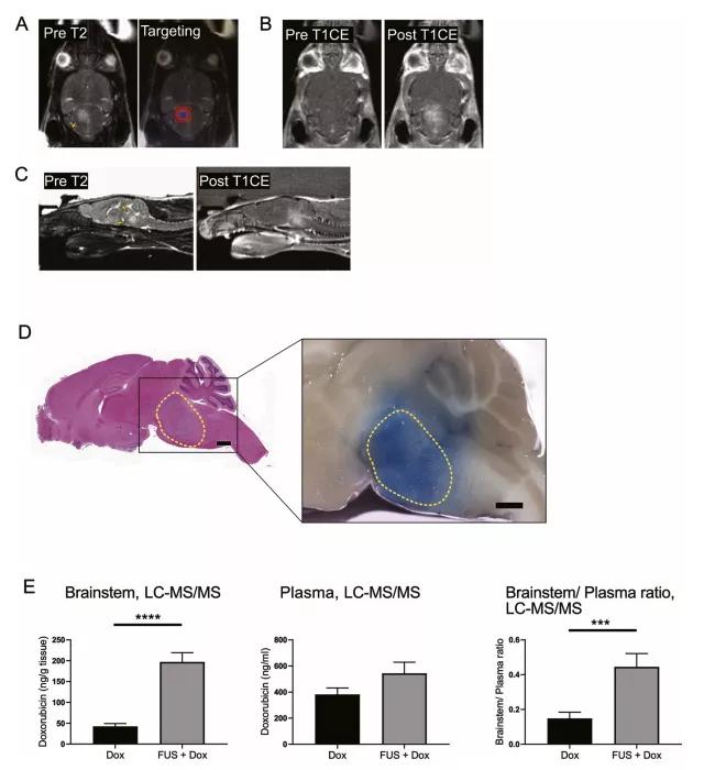 一级脑干胶质瘤,脑干胶质瘤指南