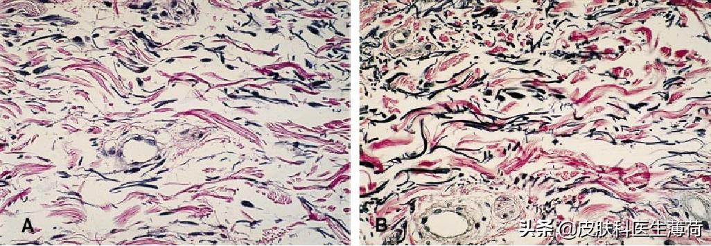 黄脸婆吃什么祛斑,告别黄脸婆自制纯中药祛斑面膜