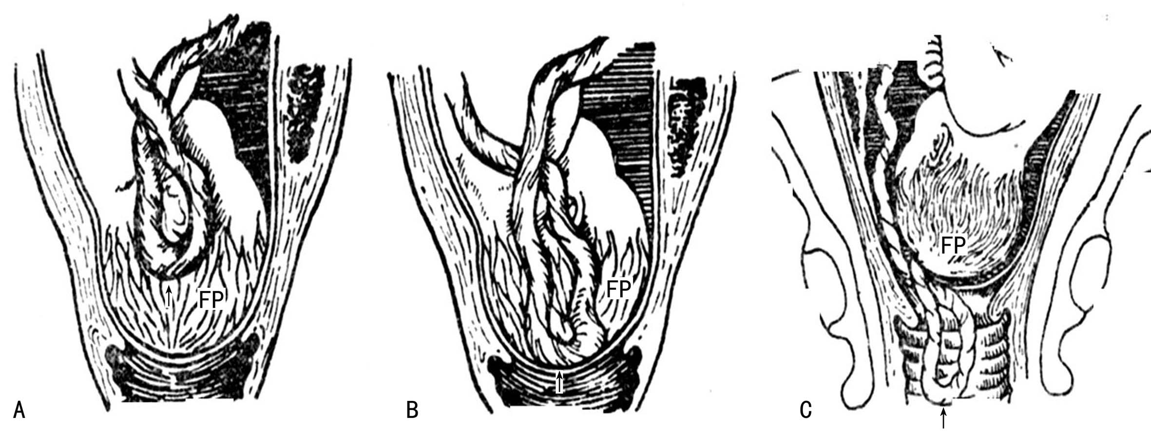 明明白白做超声（十八）：脐带超声检查二：脐带脱垂及单脐动脉