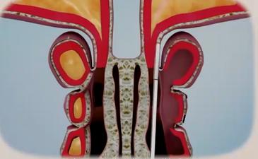 鼻窦炎怎么治疗协和,北京五官科专家治疗鼻窦炎