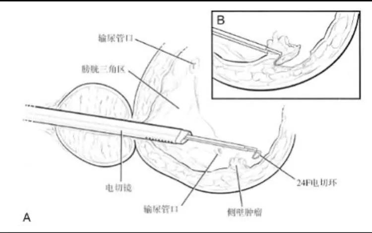 膀胱有肿瘤一定是癌症吗,通俗易懂讲解膀胱肿瘤