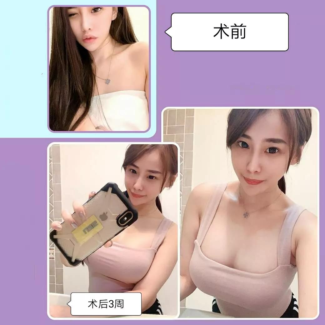 隆胸是现在胸围加上假体厚度吗,假体隆胸术后的胸围会缩一点吗